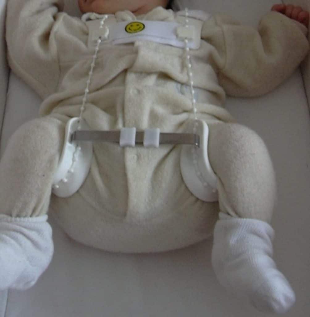 Hüftdysplasie Baby: Angelegte Tübinger Hüftbeugeschiene