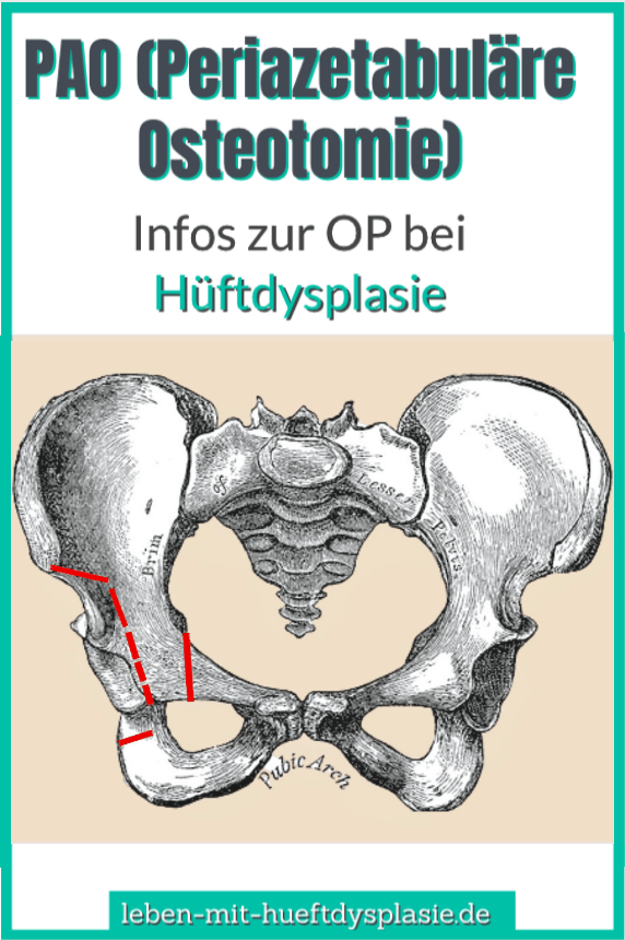 HüftdysplasieOP Die Periazetabuläre Osteotomie (PAO)