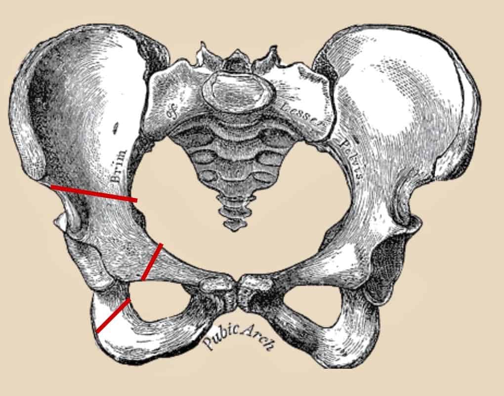 Hüftdysplasie-OP Triple-Osteotomie Knochenschnitte